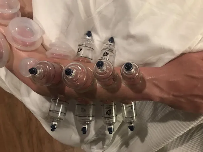 Image of: Mustafa Cupping Clinic In Arumbakkam