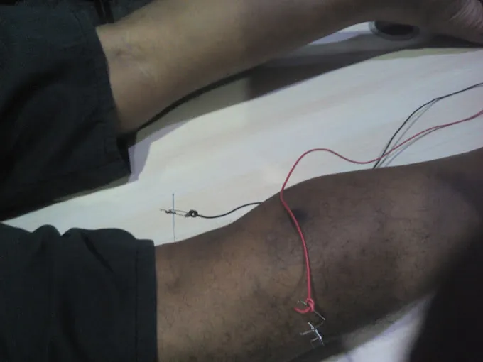 Image of: Nazirs Acuheal Acupuncture And Cupping In Arumbakkam 4