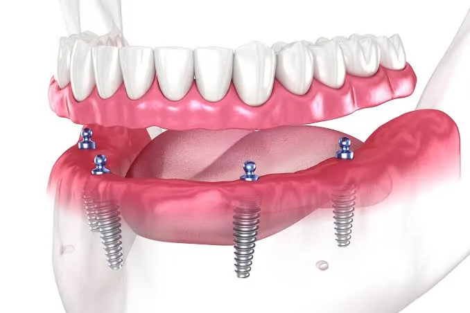 Image of: Rheya Shree Dental In Vyasarpadi 3
