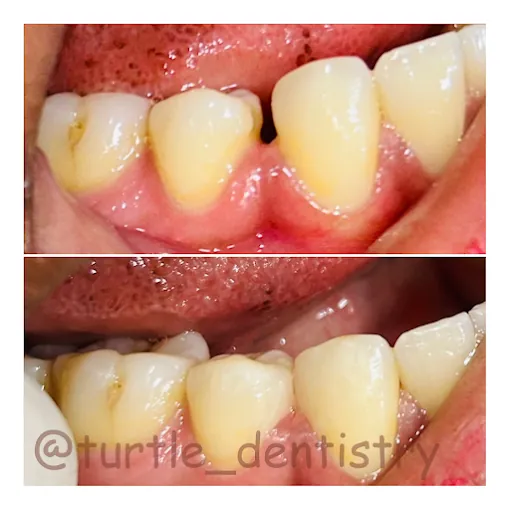 Image of: Turtle Dentistry In Chennai