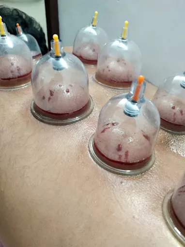 Image of: Vcure Acupuncture And Cupping Clinic In Chennai