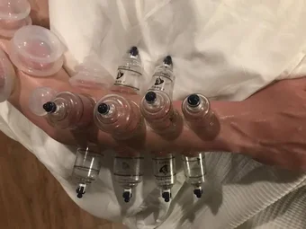 Image of: Mustafa Cupping Clinic In Arumbakkam