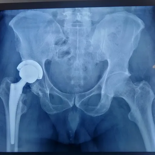 Image of: Dr Arun Kannan Best Orthopedic In Chennai 3