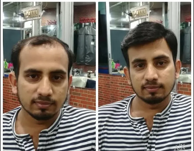 Image of: A Hair Bonding Hair Wig in Simmakkal