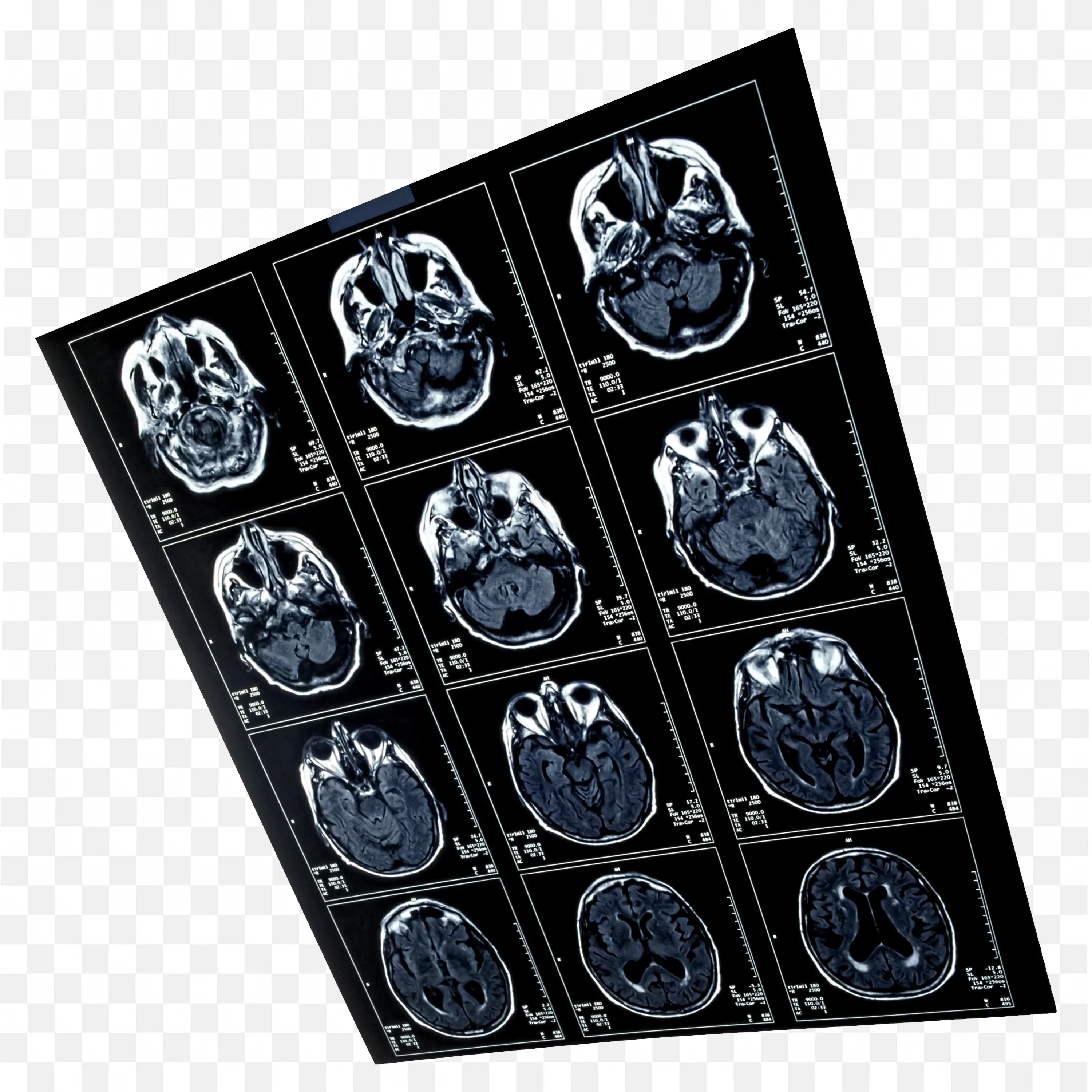 Mri Brain Scan Sheet Showing Multiple Views of Brain PNG
