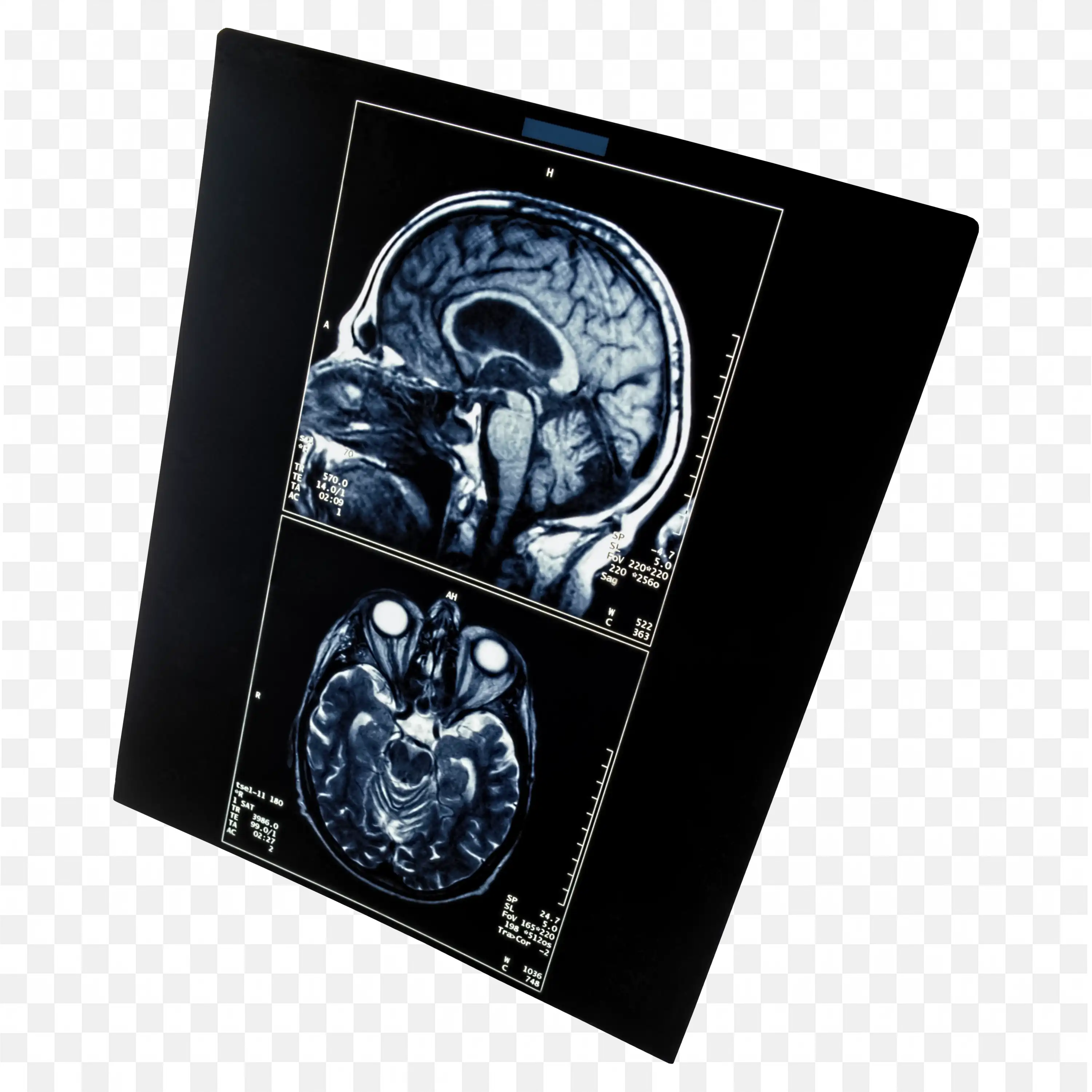 Mri Scan Image of Brain in a Black Display Frame Free PNG